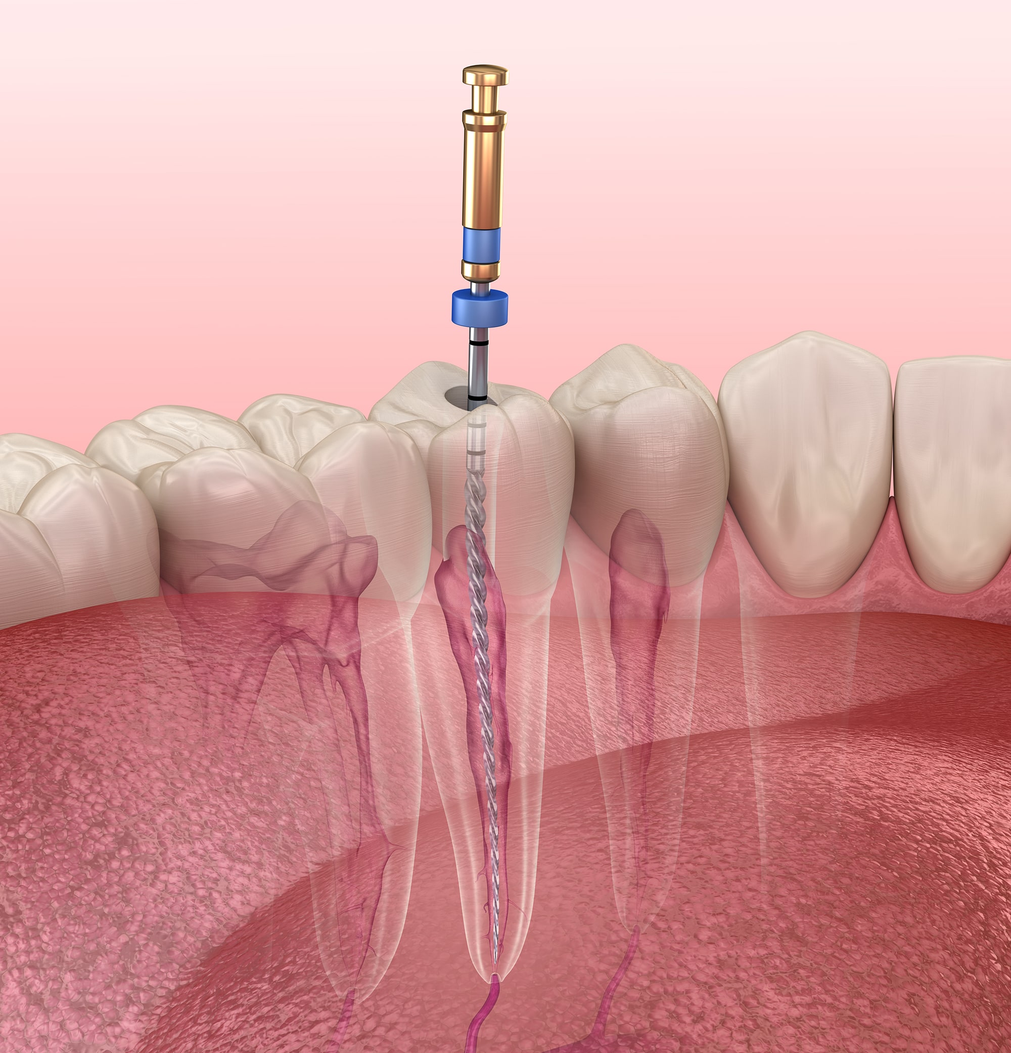 Endodoncia